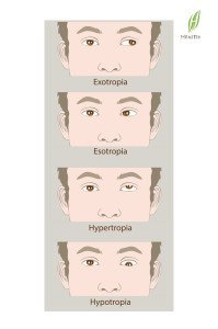 Amblyopia